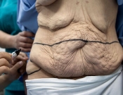 Aumento nas Cirurgias Plásticas Pós-Bariátricas Aumento nas Cirurgias Plásticas Pós-Bariátricas