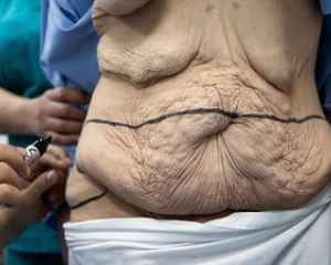 Aumento nas Cirurgias Plásticas Pós-Bariátricas Aumento nas Cirurgias Plásticas Pós-Bariátricas