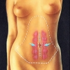 Abdominoplastia